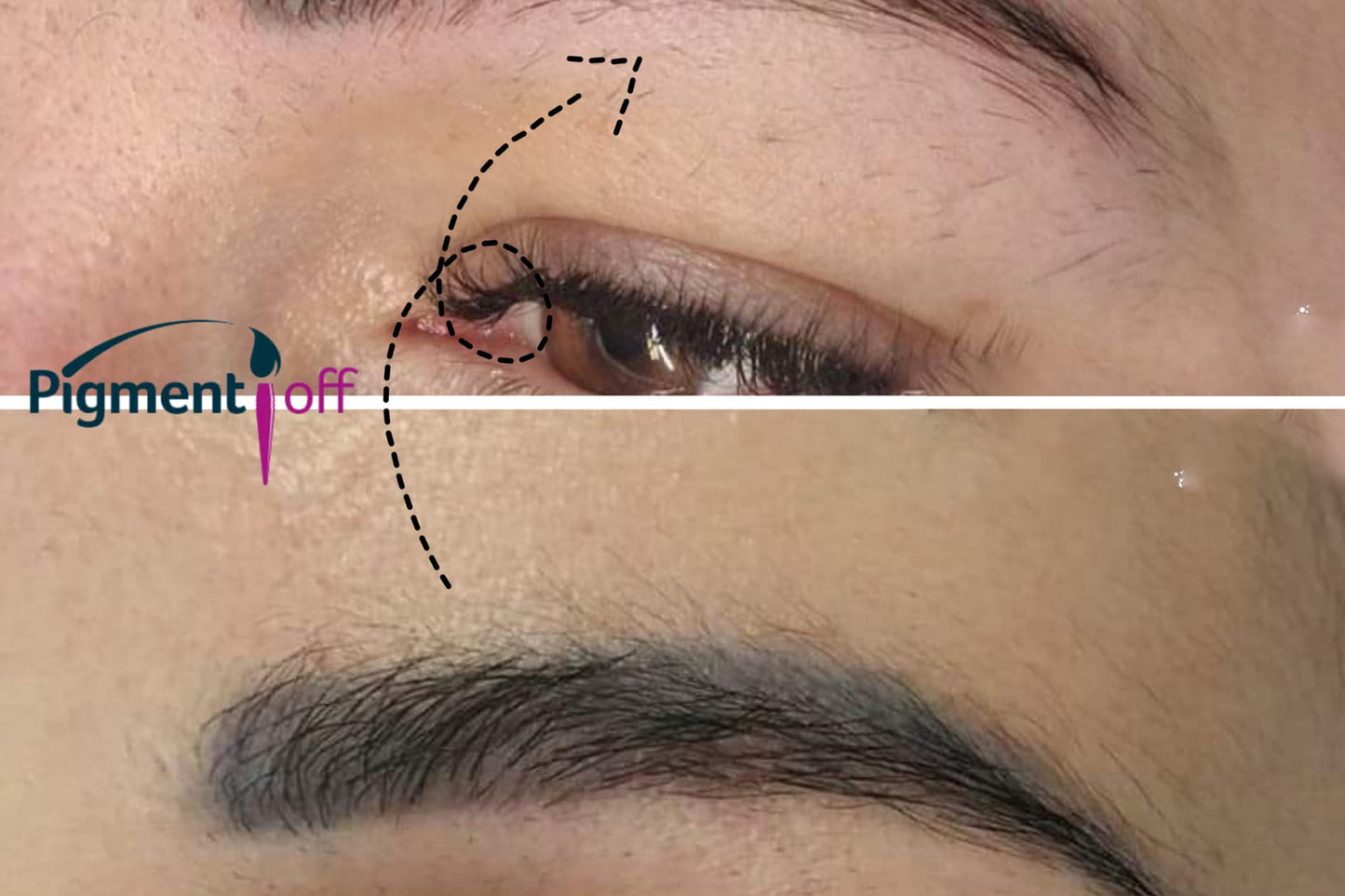 LASER TREATMENTS: (per session) - Pigment OFF Remover